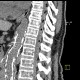 Air bubbles in spinal canal after stentgraft placement and spinal anesthesia, spinal paraparesis: CT - Computed tomography